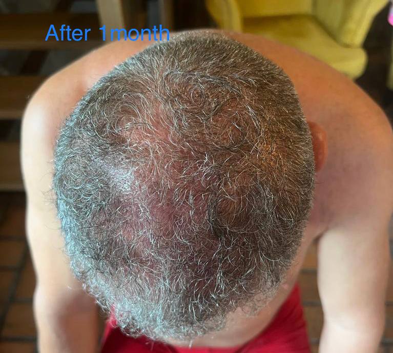 hair growth after treatment
