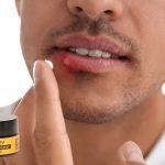 cold sore solutions